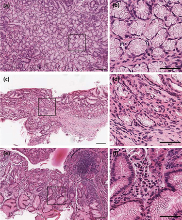 White light microscopy images of H&E stained thin sections of three different human gastric endoscopy biopsies: (a) healthy control (c) chronic gastritis; (e) gastric cancer. The insets (b), (d) and (f) show the enlarged black box zones of the images (a), (b) and (e), respectively. The scale bar is 200 μm in (a), (c) and (e) and 100 μm in (b), (d) and (f).