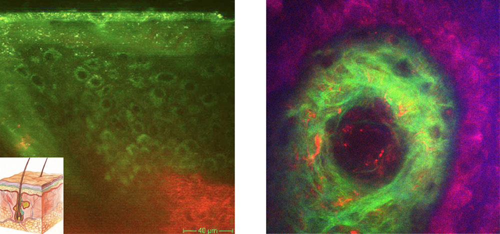 Optical biopsies taken with the multimodal multiphoton tomograph. Left: vertical skin section. Right: horizontal 0.2x02.mm2 overlay section (blue: confocal reflectance, red: two-photon excited autofluorescence, green: SHG of collagen) in a skin depth of 80 μm.