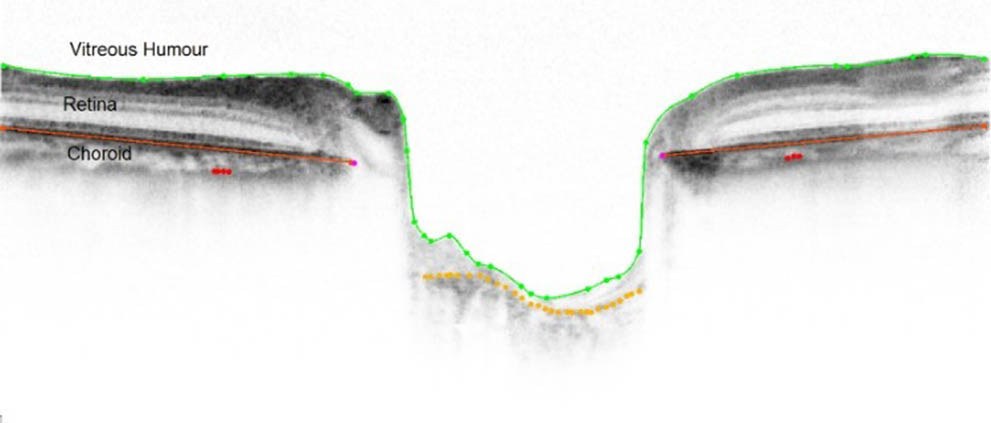 SDOCT image with retinal pigment epithelium layers (RPE, solid red line), internal limiting membrane (ILM, solid green line), and choroid representation.