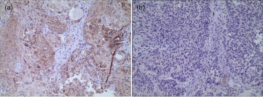 Expression of XRCC1 in ESCC (SP method, ×200): (a) XRCC1 positive, with cytoplasm and nuclei, yellowish-brown particles; (b) XRCC1 negative expression