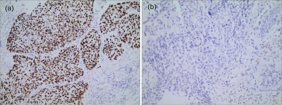 Expression of PARP-1 in ESCC (SP method, ×200): (a) PARP-1 positive, with cytoplasm and nuclei, yellow-brown granules; (b) PARP-1 negative expression