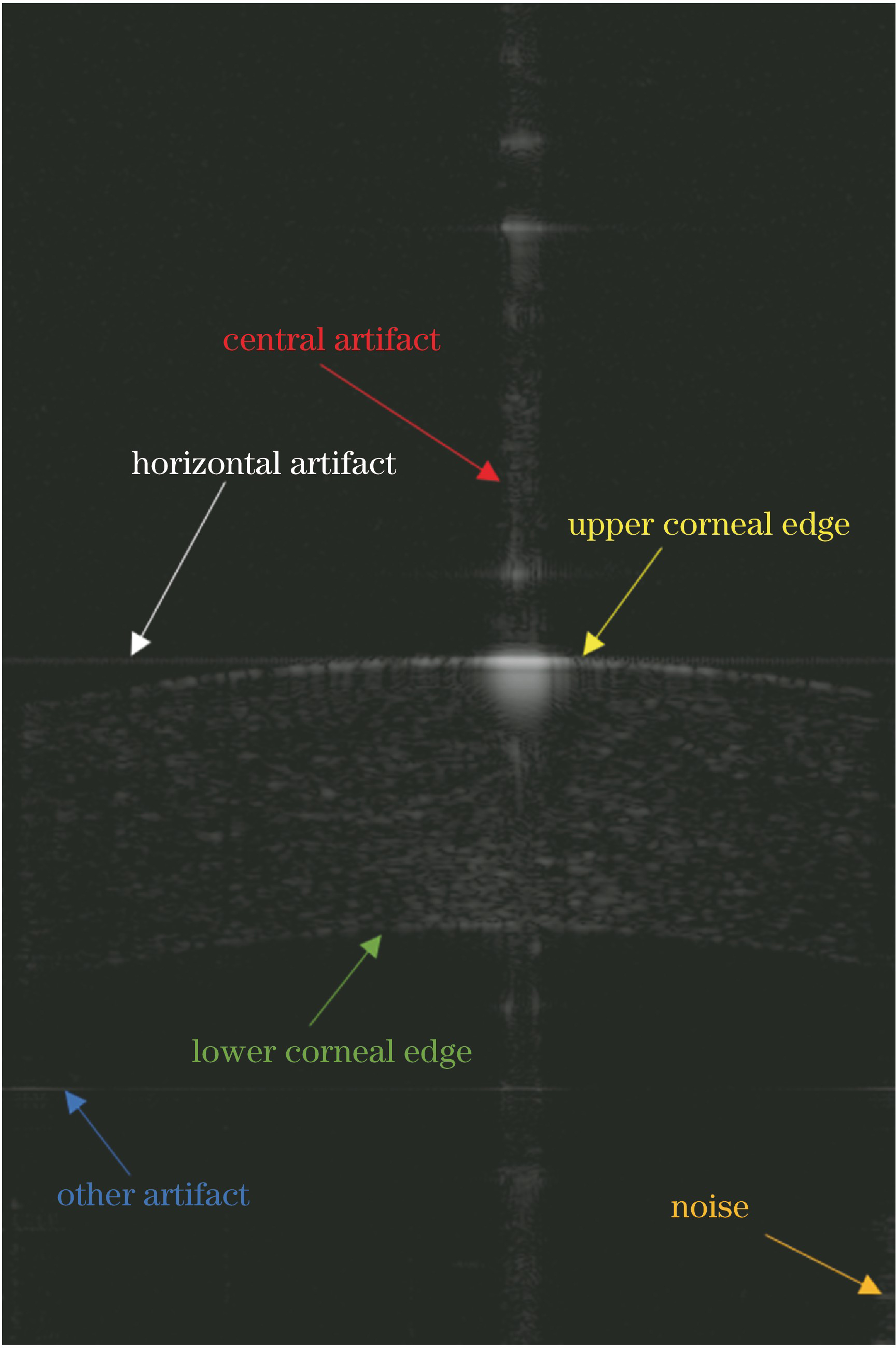 Noise and artifacts in original cornea B scan image