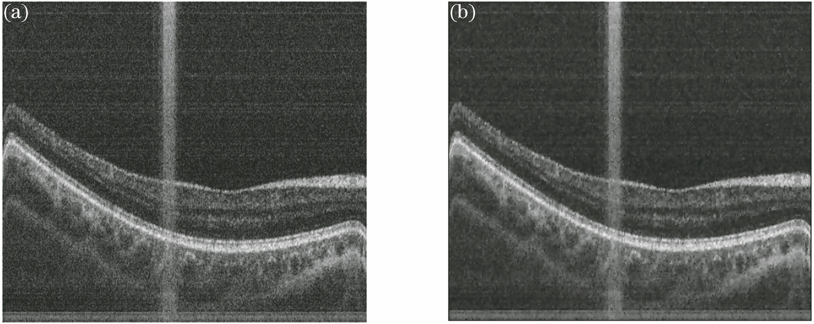 (a) Original OCT retinal image and (b) filtered image
