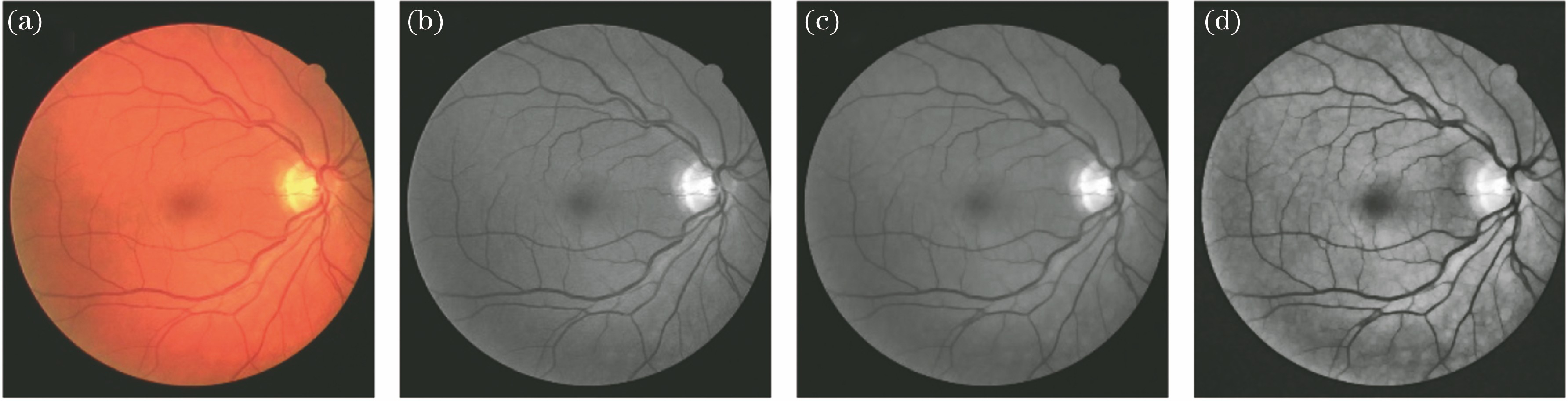 Images of the pre-processing results. (a) Color fundus image; (b) green channel; (c) morphological open operation of Fig. 2(b); (d) image enhancement of Fig. 2(c) by CLAHE
