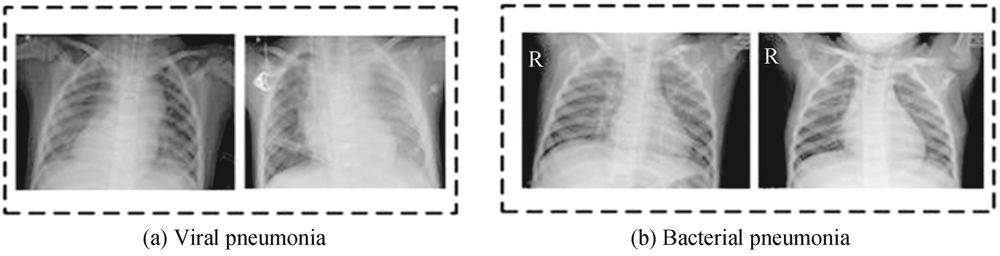 Examples of lung X-ray images