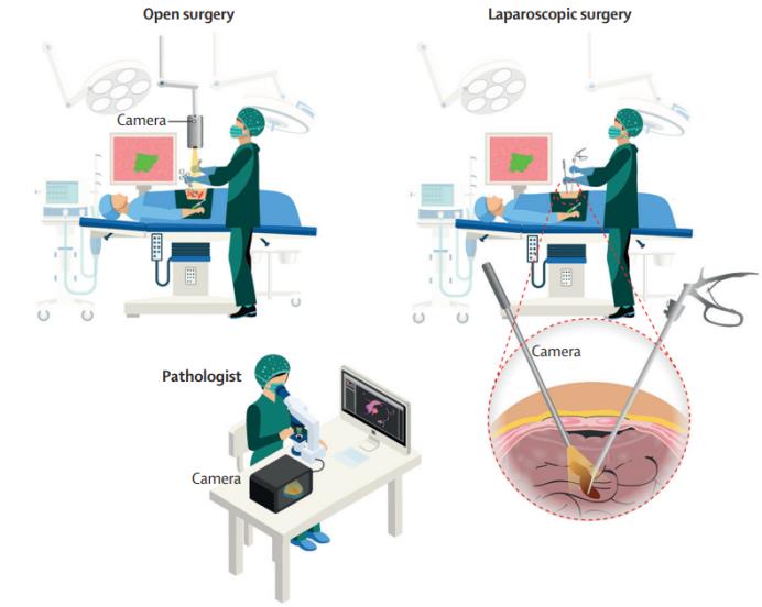 All imaging equipments can be integrated into a compact open-field device or within laparoscopic and other surgical instruments for contact-free and real-time imaging［26］.