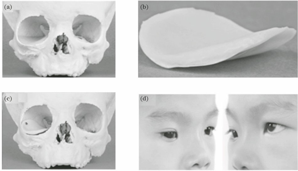 (a) Preoperative skull model with deformed orbital bone; (b) implant; (c) model with implant; (d) pictures after surgery