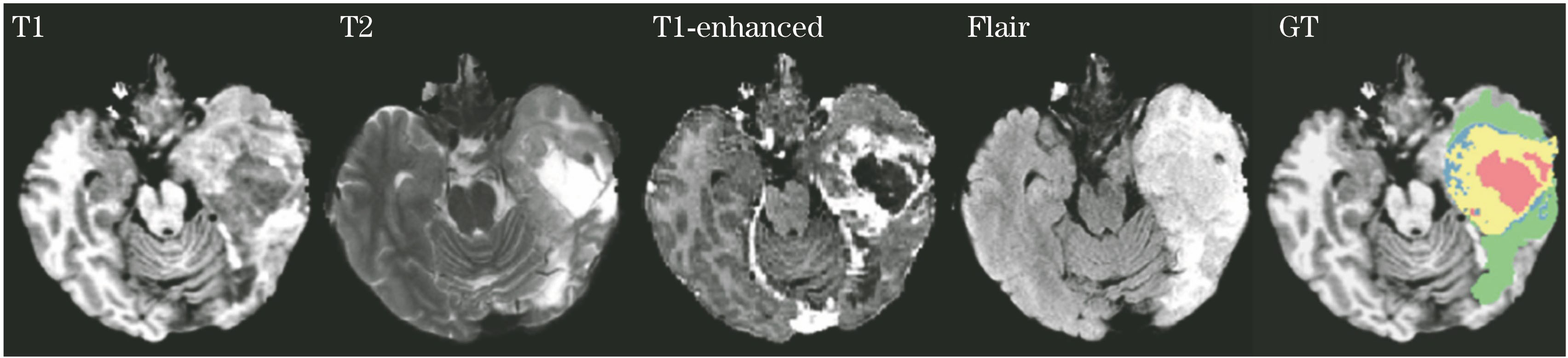 Four types of brain tumor MRI images and the expert segmentation result