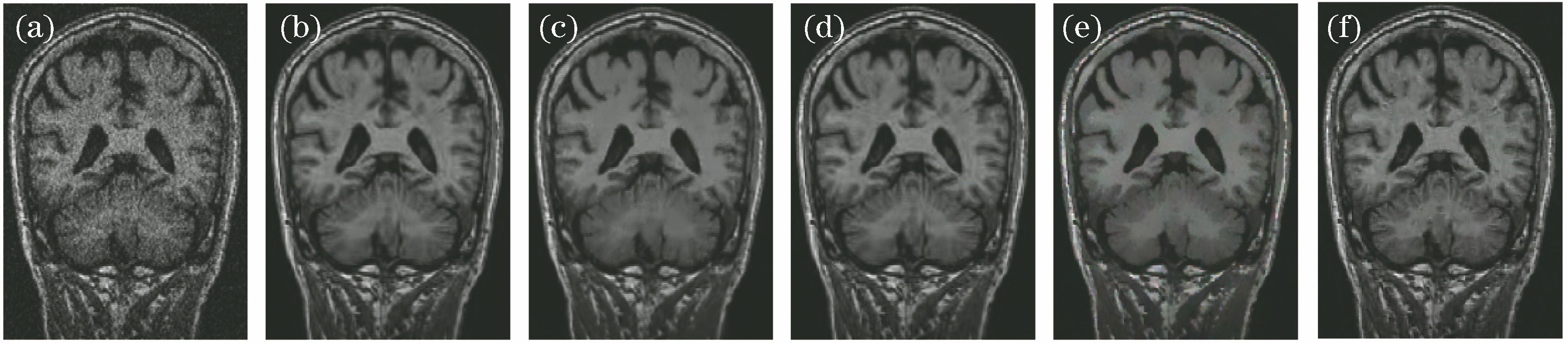 Comparison of denoising effects of noised MRI brain slices by various algorithms. (a) MRI slice with noise; (b) denoising effect by RM algorithm; (c) denoising effect by BM3D algorithm; (d) denoising effect by WSNM algorithm; (e) denoising effect by WNNM algorithm; (f) denoising effect by proposed algorithm