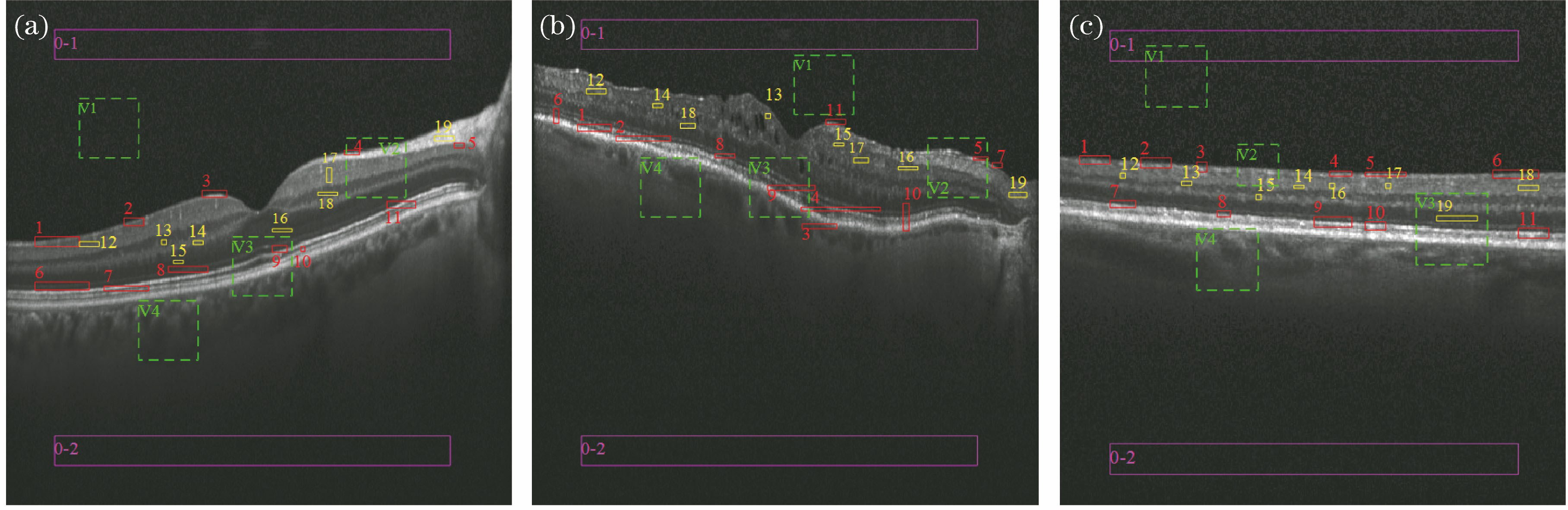 OCT B-scan images of human retina. (a) Normal retina image; (b) DME retina image; (c) Drusen retina image