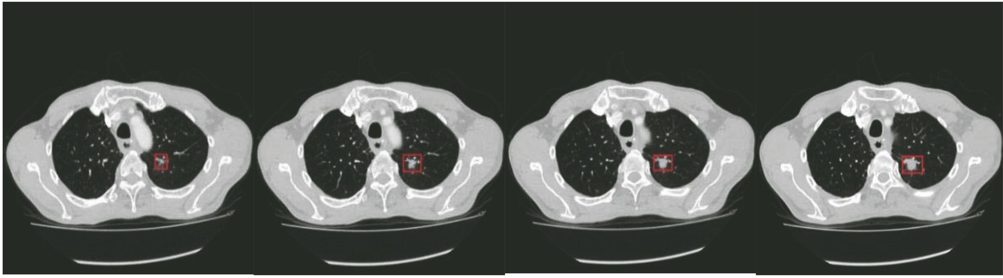 CT images of lung