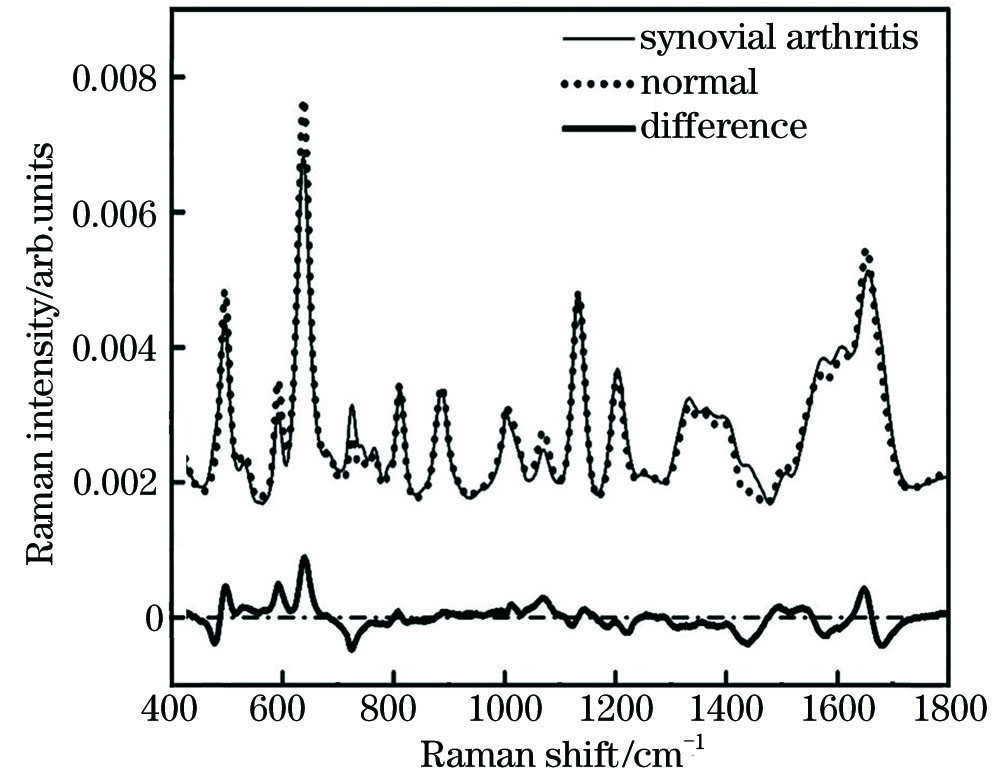 SERS average spectra and different spectra of joint fluid from arthritis patients(n=18) and normal people(n=15)