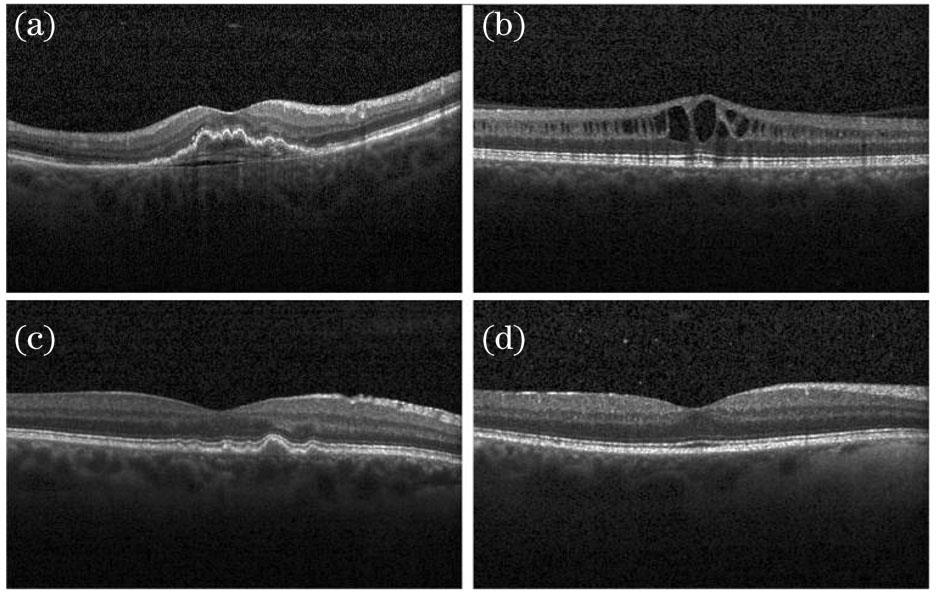 OCT images of diabetic retinopathy. (a) Choroidal neovascularization; (b) diabetic macular edema; (c) drusen; (d) normal retina
