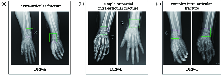 Examples of 3 specific fracture types of DRF. (a) DRF-A; (b) DRF-B; (c) DRF-C