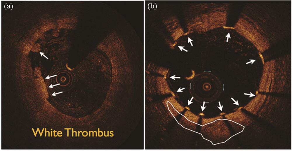 OCT intravascular luminal imaging cross-section[5]. (a) Identification of thrombus; (b) identification of stent