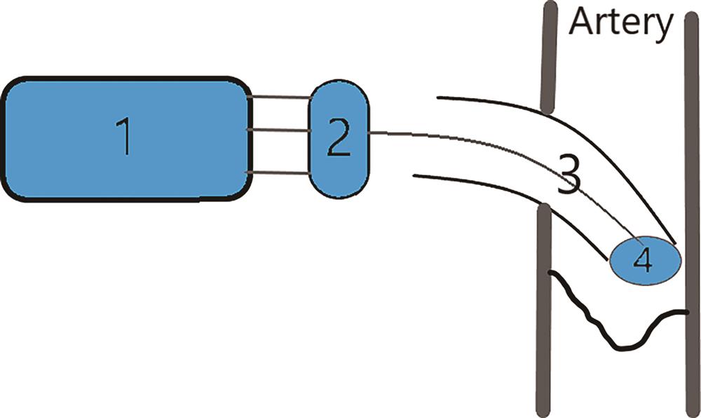 Constitution of CVX-300 laser system[2]. (1: a laser; 2: a connector; 3:a laser catheter with optical fiber transmitting the laser energy into the artery; 4: a catheter tip)