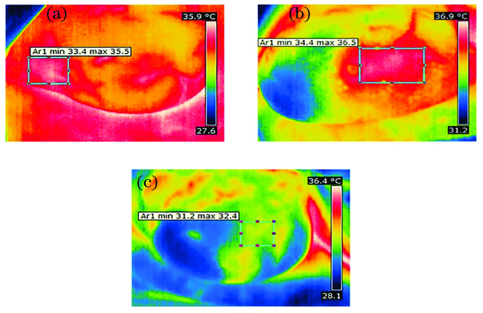 Infrared thermograms of breast masses[6]. (a)Patient with invasive ductal carcinoma; (b)patient with fibroadenoma; (c)patient with cyst