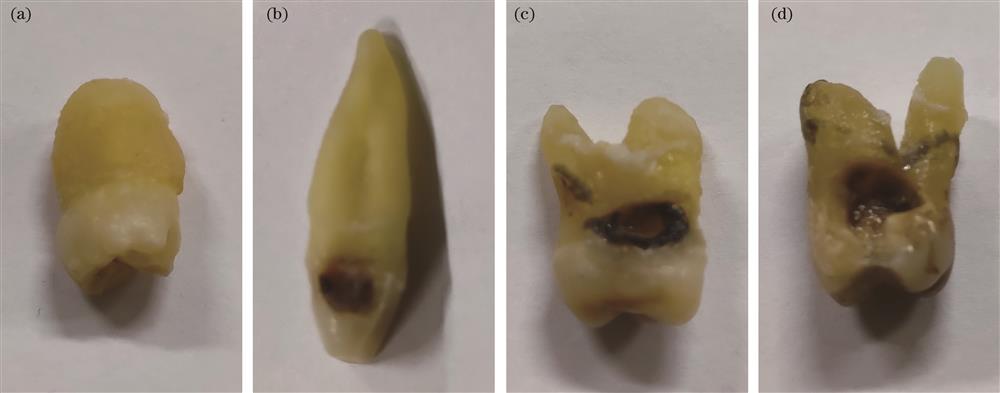 Samples of teeth with different degrees of caries. (a) Healthy teeth; (b) shallow caries; (c) moderate caries; (d) deep caries