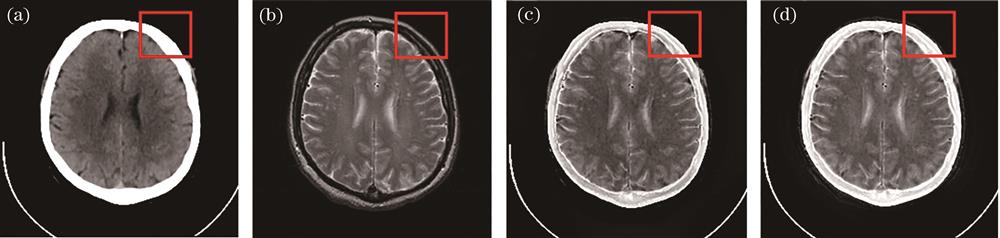 Fusion results obtained by the CNN and NSCT-PAPCNN methods. (a) Source CT image; (b) source MR-T2 image; (c) CNN; (d) NSCT-PRPCNN