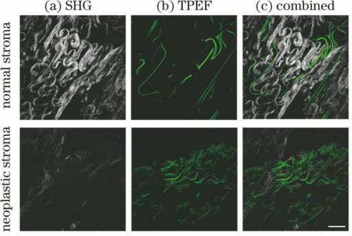 (a) SHG, (b) TPEF, (c) combined SHG (grey) and TPEF (green) images of the human esophageal stroma[25] (excitation wavelength is 850 nm, scale bar is 20 μm)